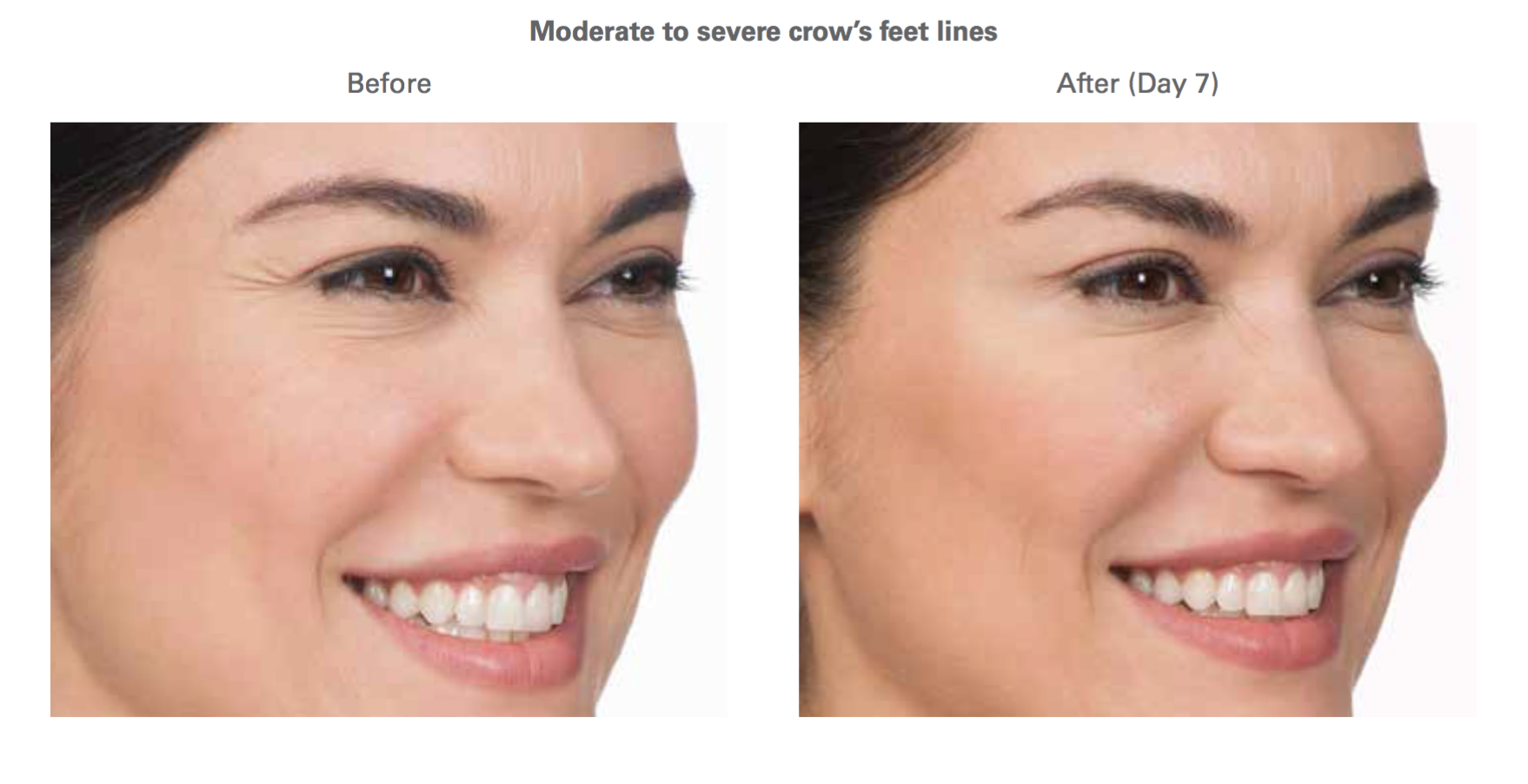 Facial & Lip Injectable Fillers Skin Fillers Prices Plano Dallas